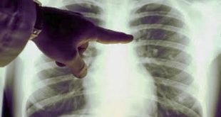 Информационна кампания и безплатни прегледи за туберкулоза в Плевен от 8 до 12 декември