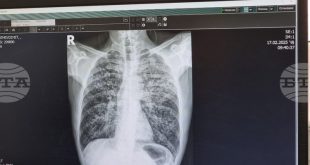 УМБАЛ Д-р Георги Странски в Плевен започва безплатни прегледи за оценка на риска от белодробна туберкулоза от 23 до 27 март
